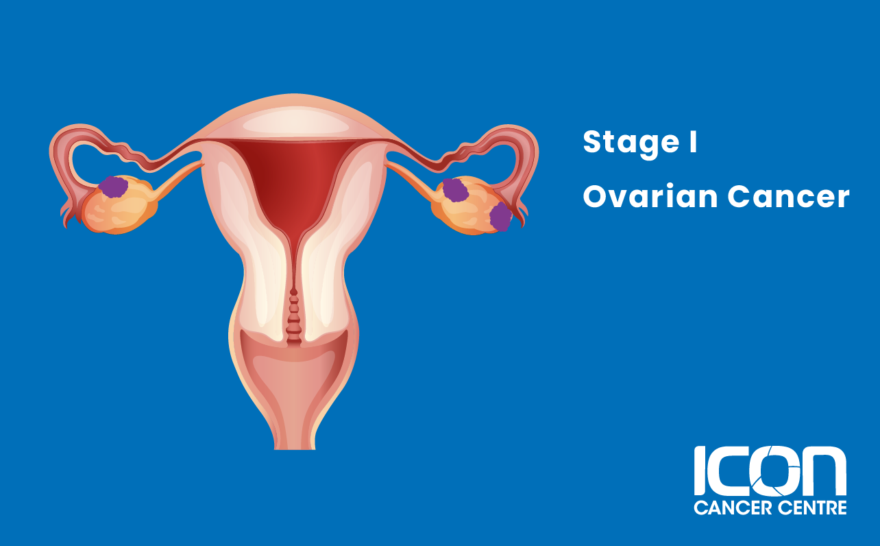Stage I ovarian cancer illustration