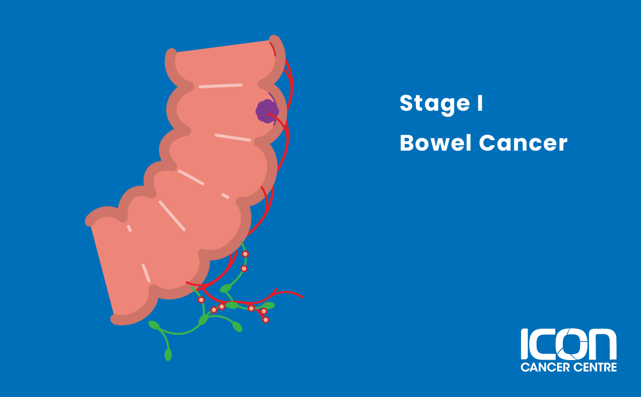 Stage I bowel cancer illustration