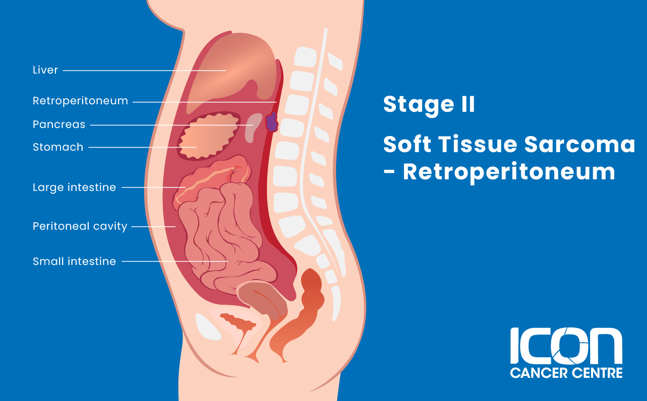 Stage II soft tissue sarcoma in retroperitoneum illustration