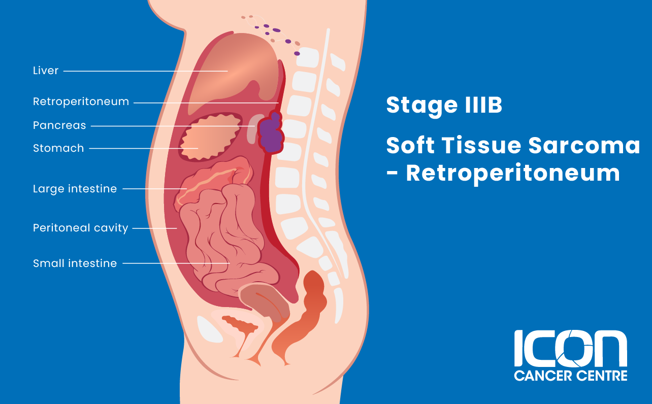 Stage IIIB soft tissue sarcoma in retroperitoneum illustration