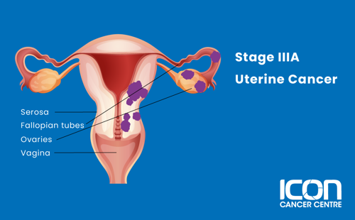 Stage IIIA uterine cancer illustration