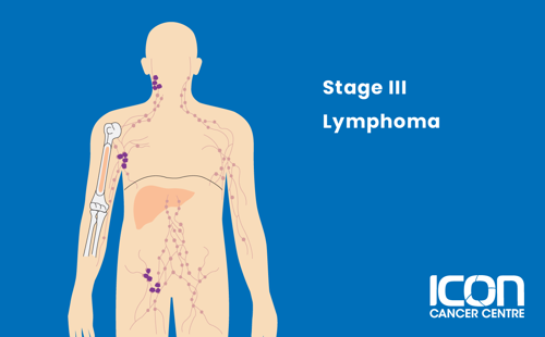 Stage III lymphoma illustration