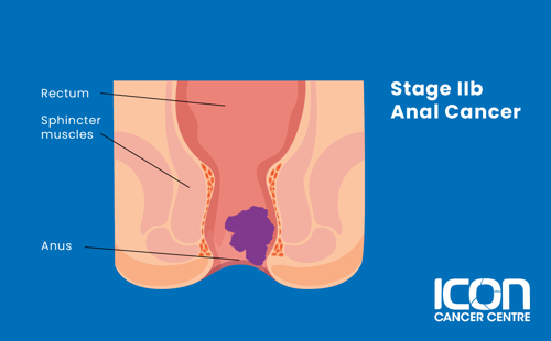 Stage IIB anal cancer illustration