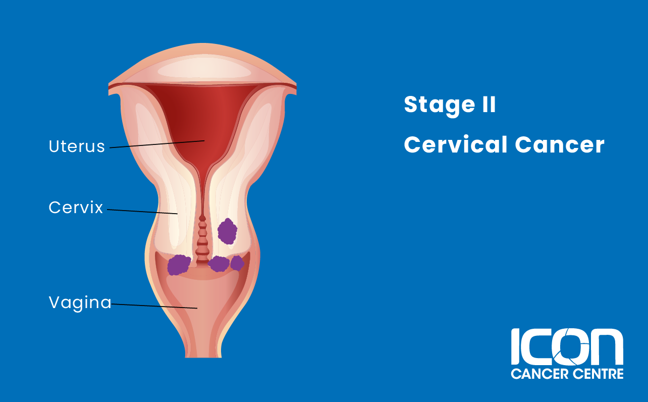 Stage II cervical cancer illustration
