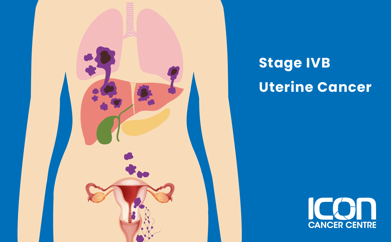 Stage IVB uterine cancer illustration