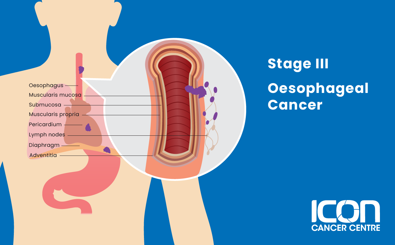 Stage III oesophageal cancer illustration