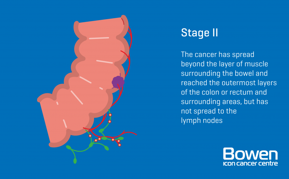 What is Bowel Cancer? Bowel Cancer Explained — Bowen Icon Cancer Centre