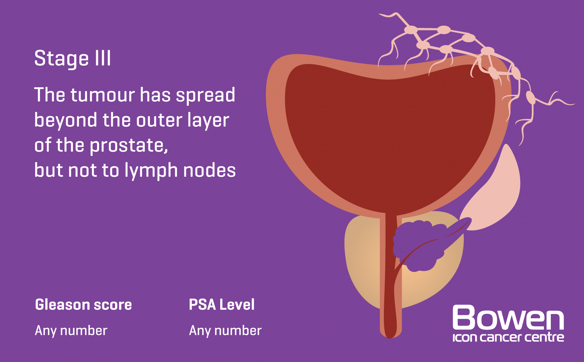 What is Prostate Cancer? Prostate Cancer Explained — Bowen