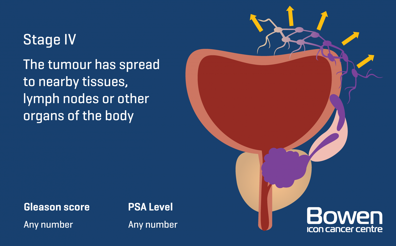 Stage 4 Metastatic Prostate Cancer