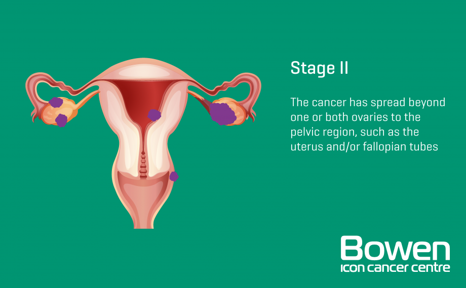 What Is Ovarian Cancer Ovarian Cancer Explained — Bowen Icon Cancer Centre