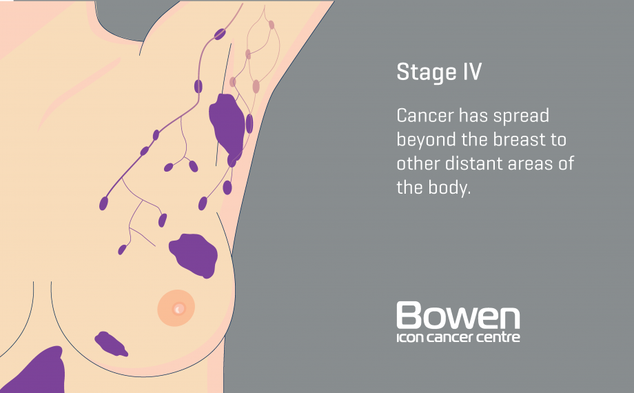 What is Breast Cancer? Breast Cancer Explained — Bowen Icon Cancer Centre