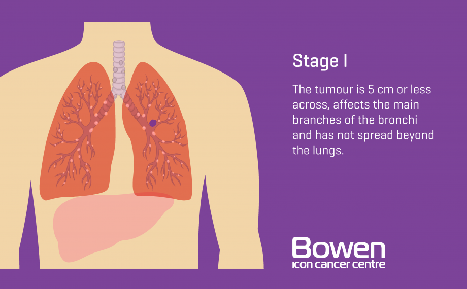 Stage1 Lung Bowen 920x570 