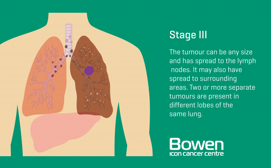 What is Lung Cancer? Lung Cancer Explained — Bowen Icon Cancer Centre
