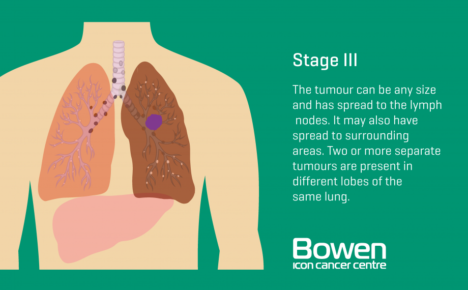 Treatment for lung cancer stage 1