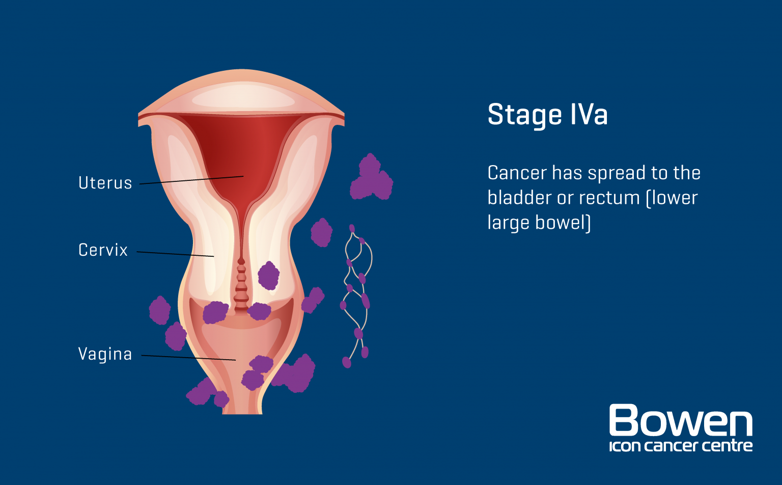 What Is Cervical Cancer Cervical Cancer Explained — Bowen Icon Cancer Centre 5726