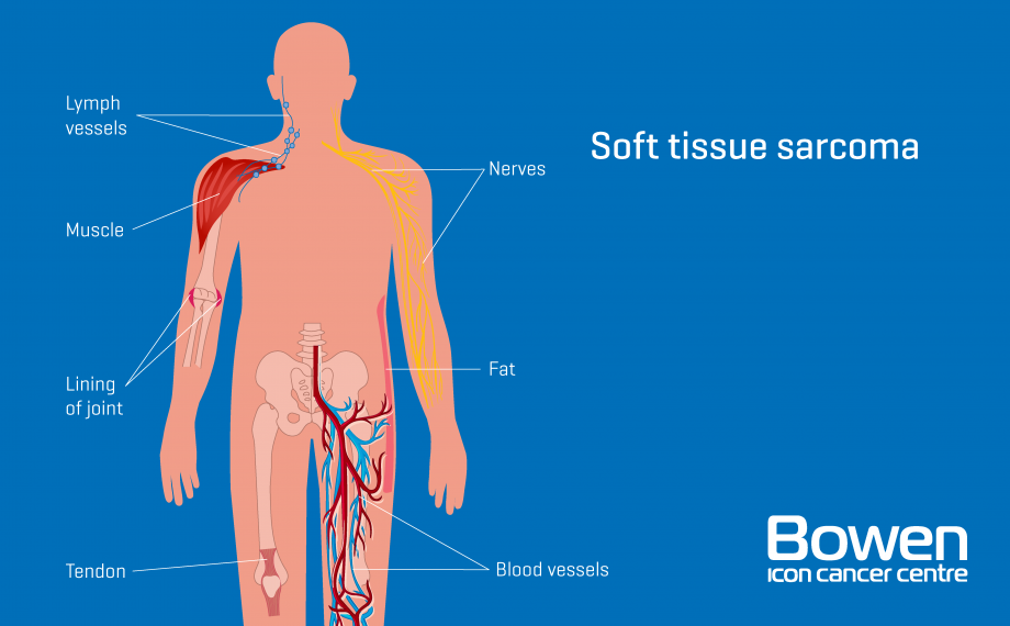 What is Soft Tissue Sarcoma? Soft Tissue Sarcoma Explained — Bowen Icon  Cancer Centre